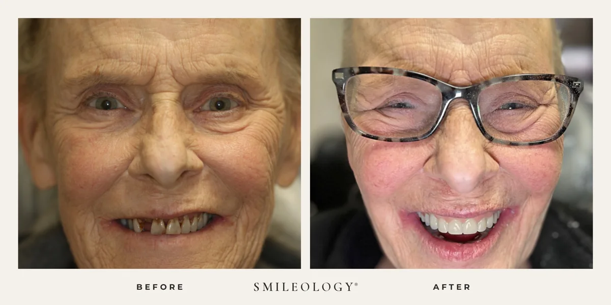 Smileology&reg; patient before and after treatment, case BA 36