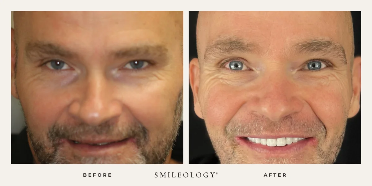 Smileology&reg; patient before and after treatment, case BA 37