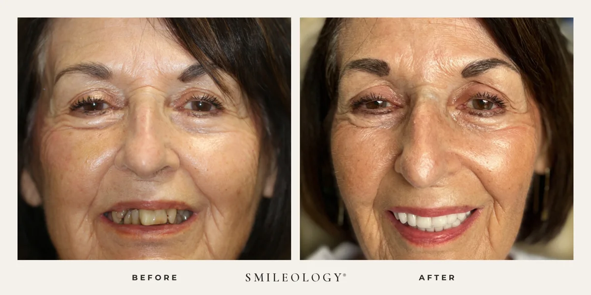 Smileology&reg; patient before and after treatment, case BA 38