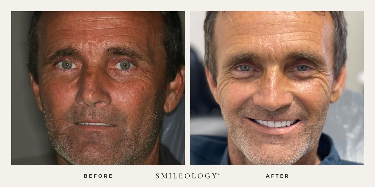 Smileology&reg; patient before and after treatment, case BA 43