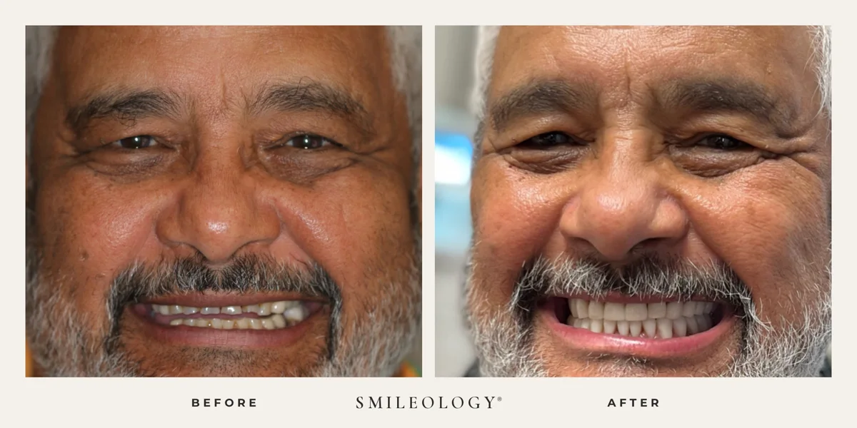 Smileology&reg; patient before and after treatment, case BA 40