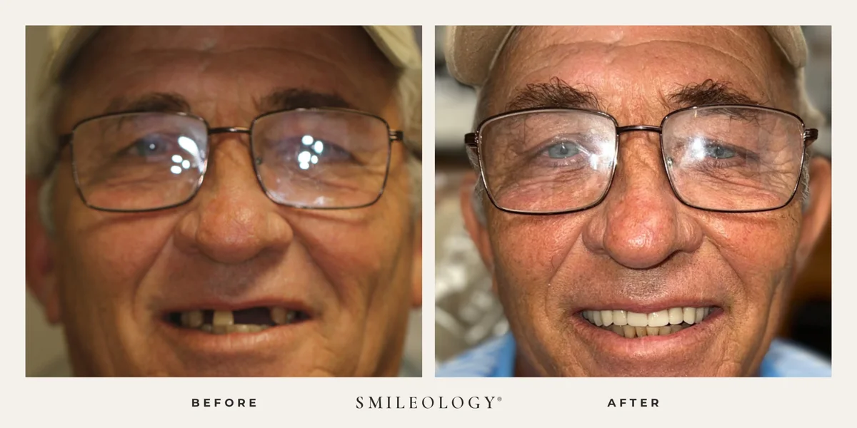 Smileology&reg; patient before and after treatment, case BA 42