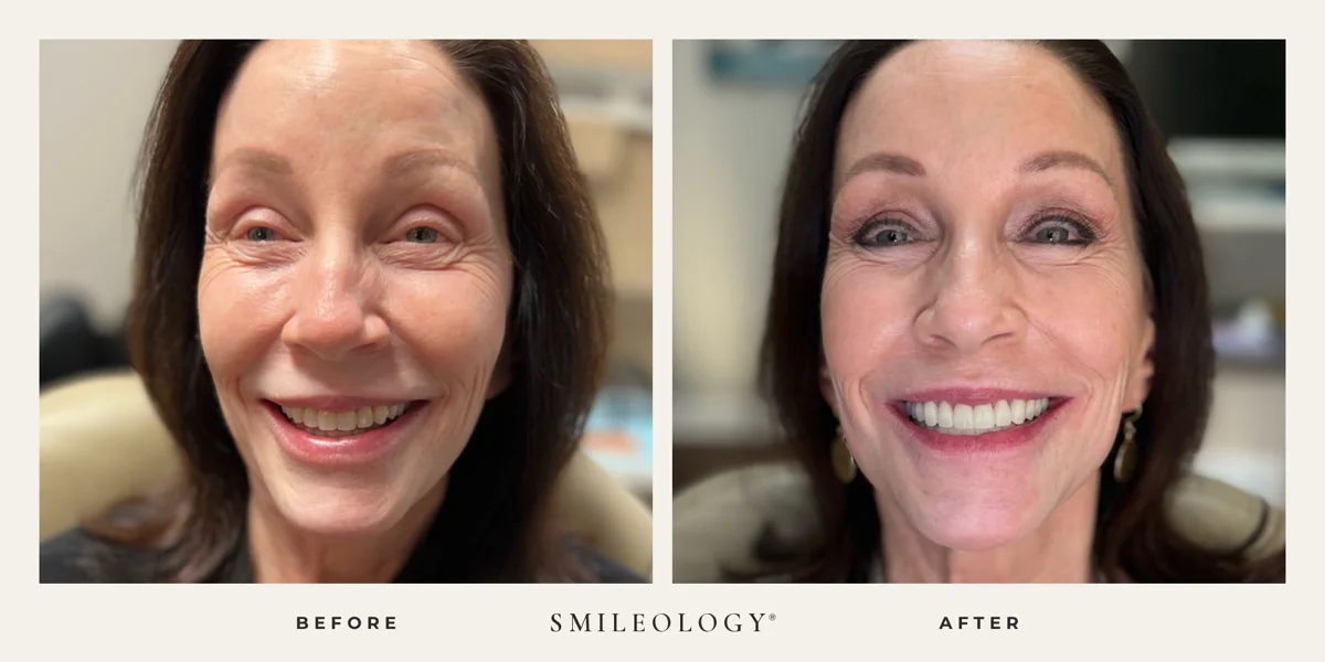 Smileology&reg; patient before and after treatment, case BA 39