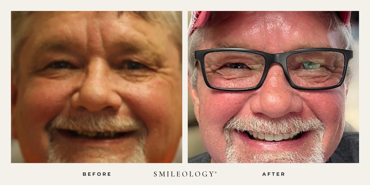 Smileology&reg; patient before and after treatment, case BA 41