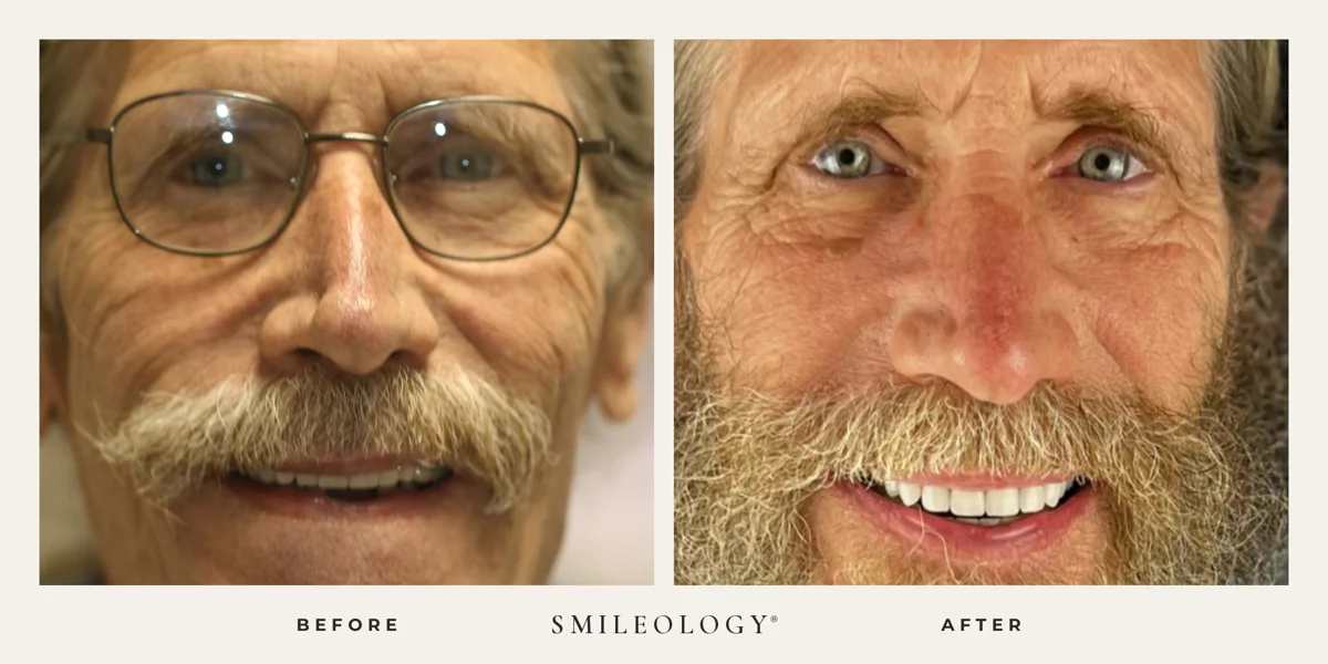 Smileology&reg; patient before and after treatment, case BA 51
