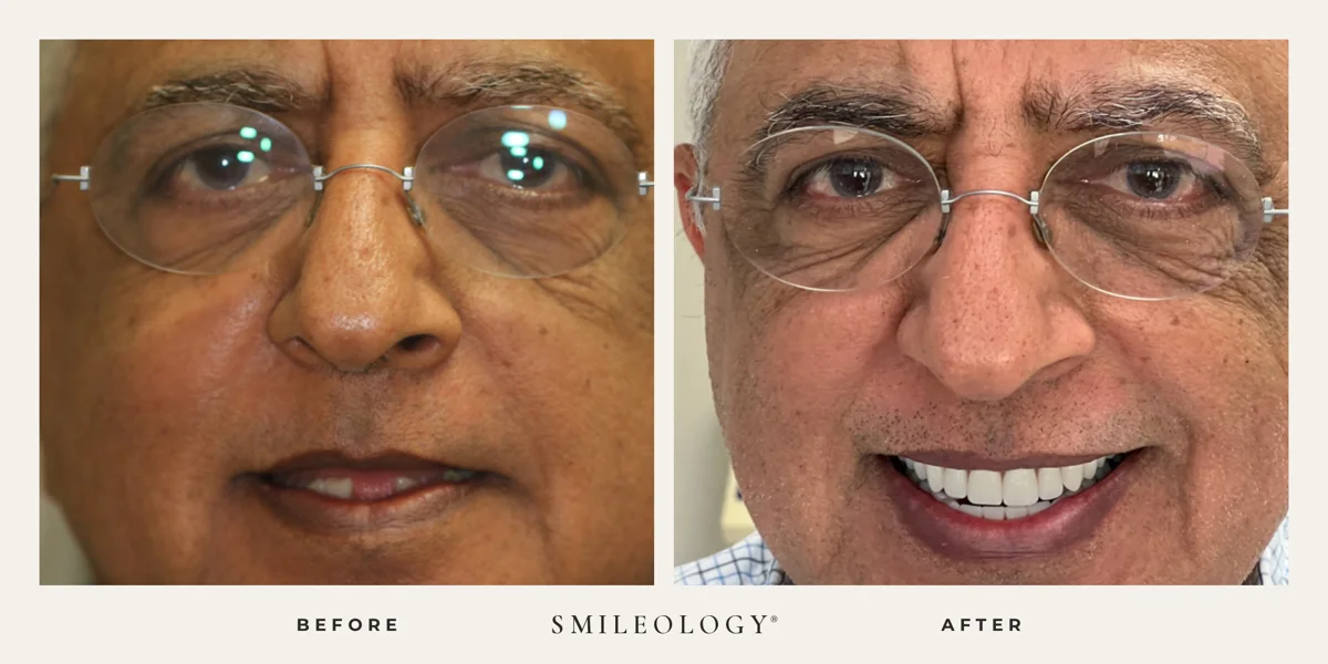 Smileology&reg; patient before and after treatment, case BA 46