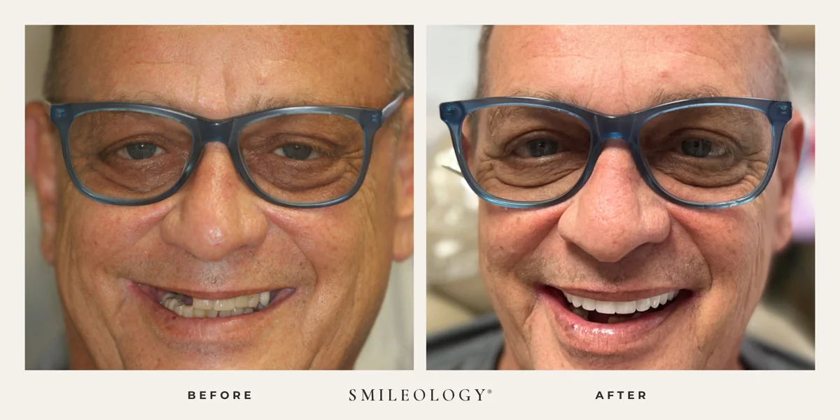 Smileology&reg; patient before and after treatment, case BA 45