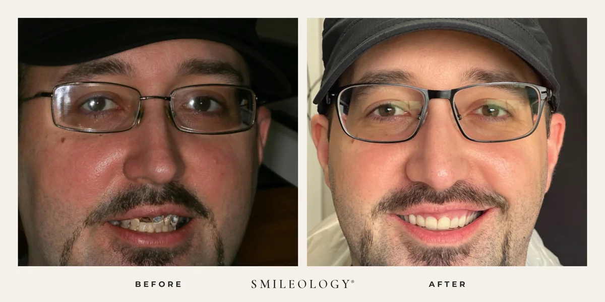 Smileology&reg; patient before and after treatment, case BA 44