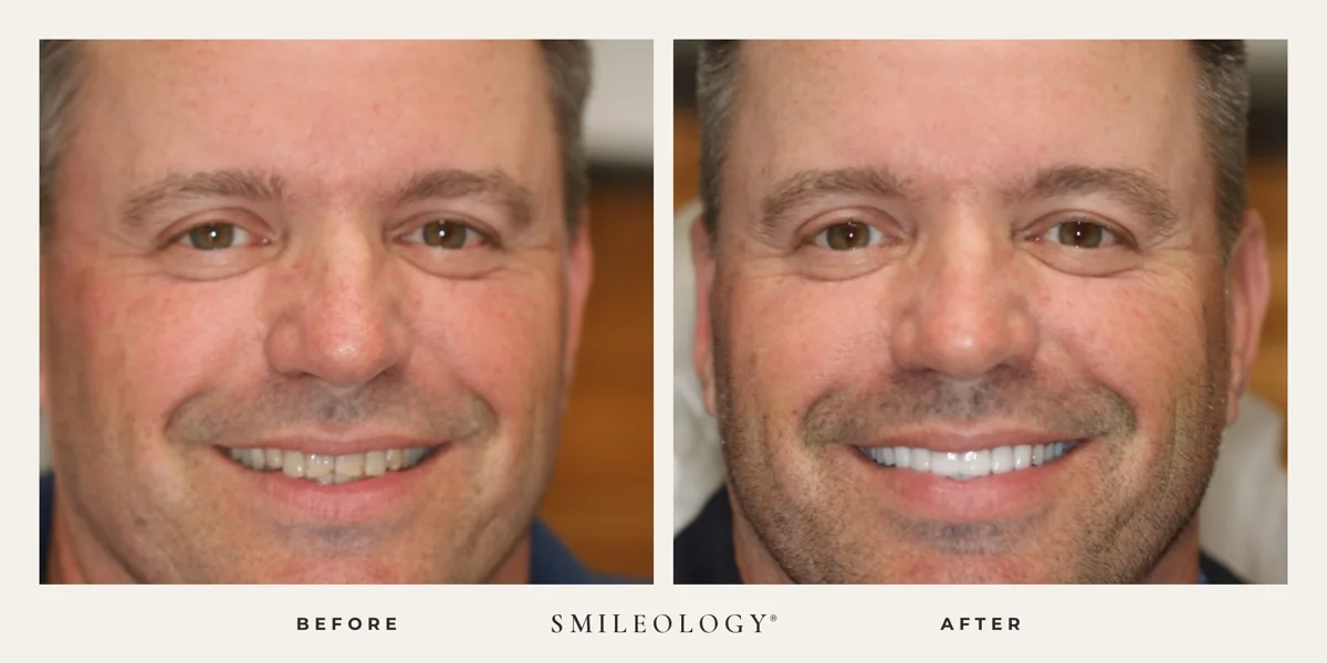 Smileology&reg; patient before and after treatment, case BA 47