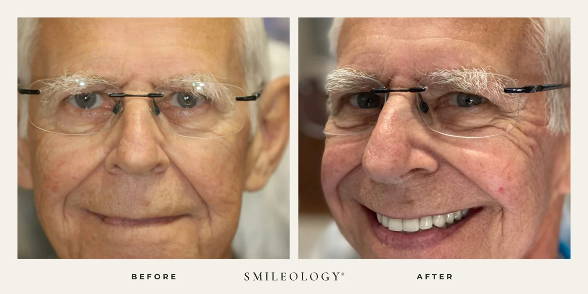 Smileology&reg; patient before and after treatment, case BA 49