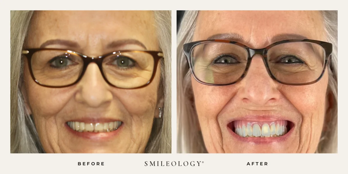 Smileology&reg; patient before and after treatment, case BA 54