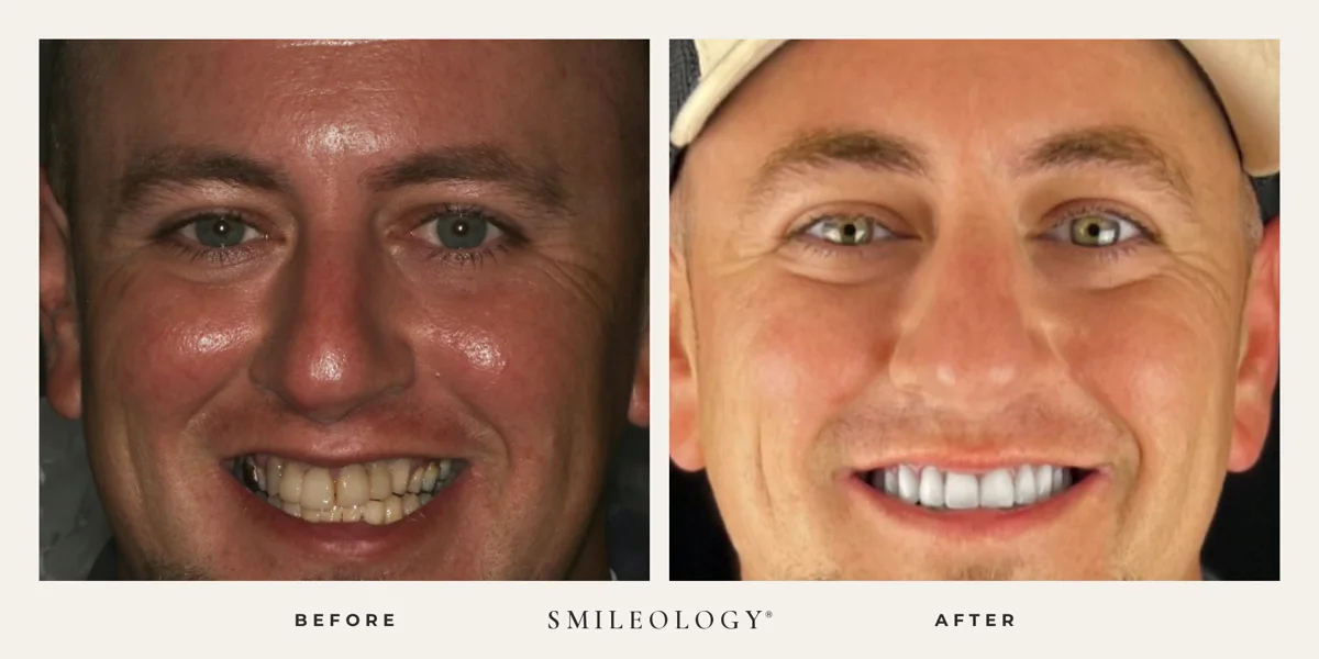 Smileology&reg; patient before and after treatment, case BA 53