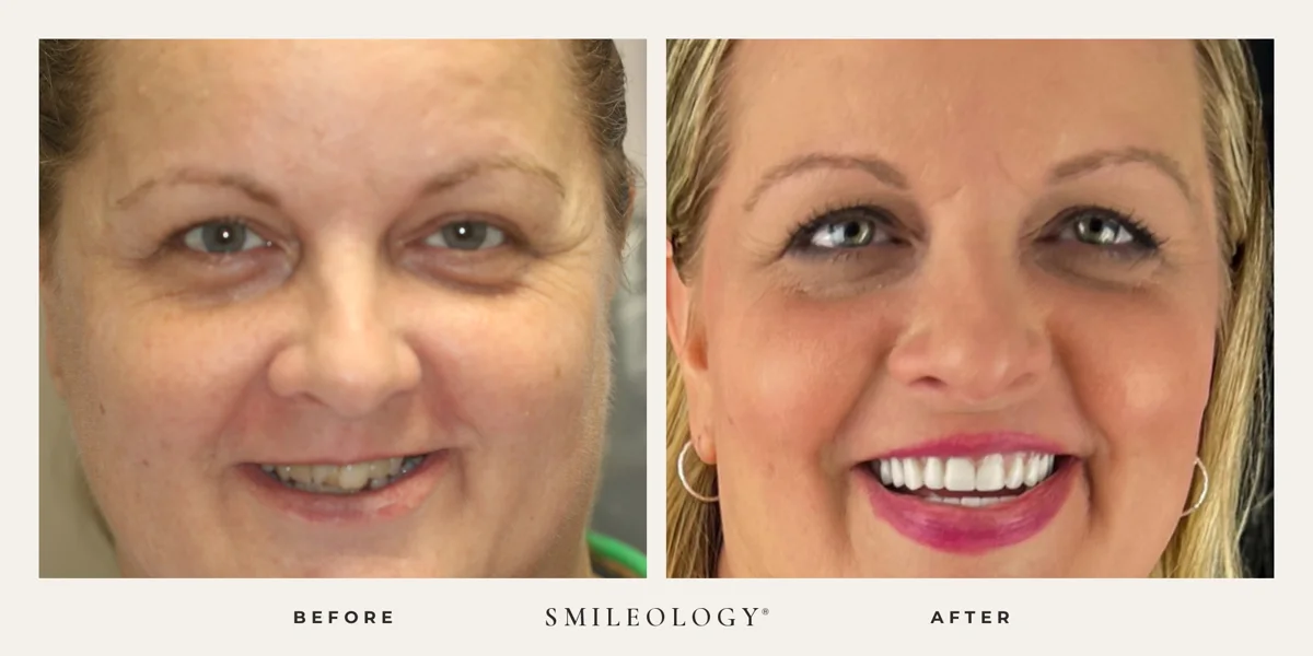 Smileology&reg; patient before and after treatment, case BA 57