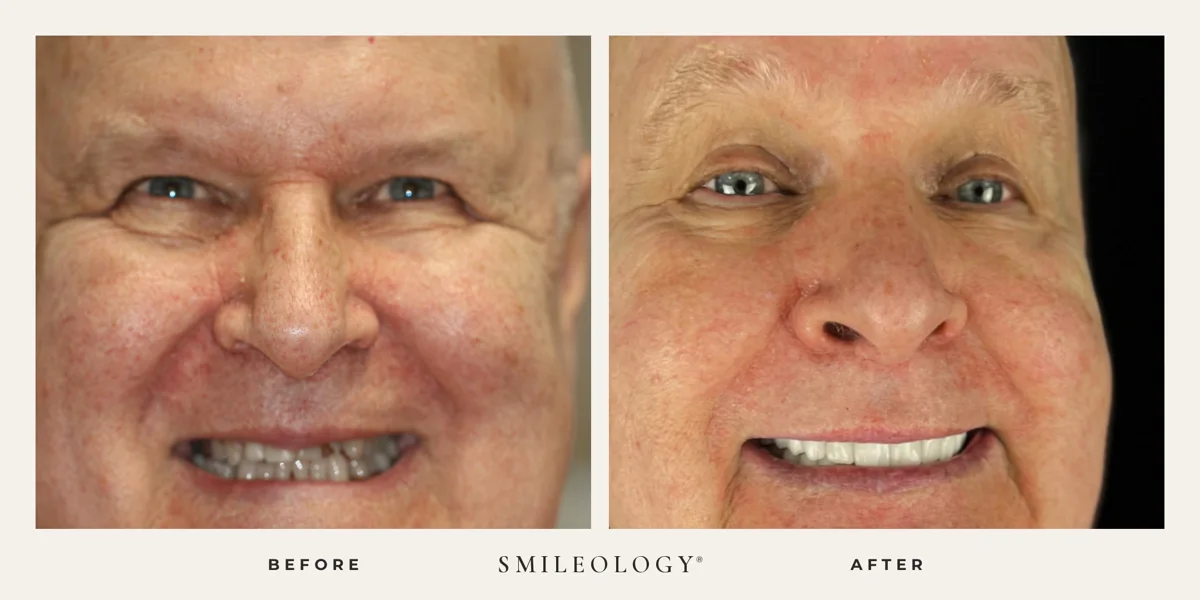 Smileology&reg; patient before and after treatment, case BA 52