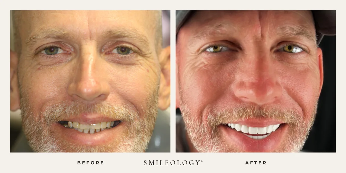 Smileology&reg; patient before and after treatment, case BA 55