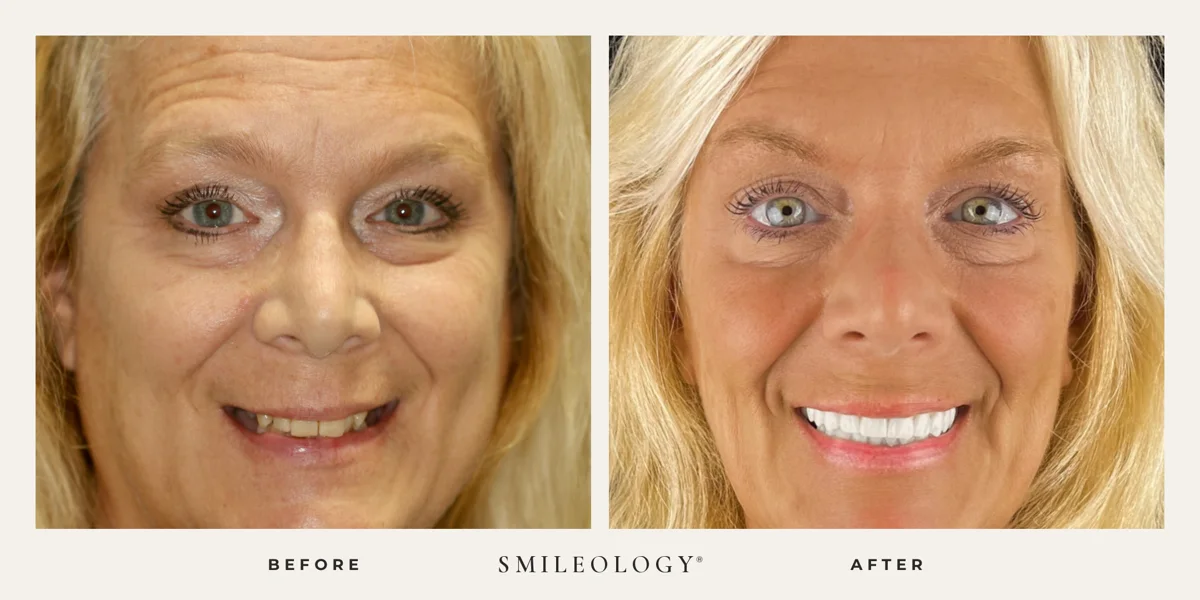 Smileology&reg; patient before and after treatment, case BA 59