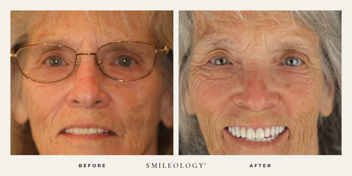 Smileology&reg; patient before and after treatment, case BA 58