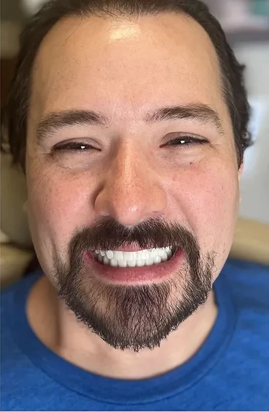 The same Smileology&reg; patient after full-arch treatment