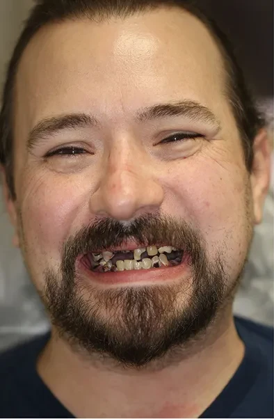 Smileology&reg; patient before full-arch treatment