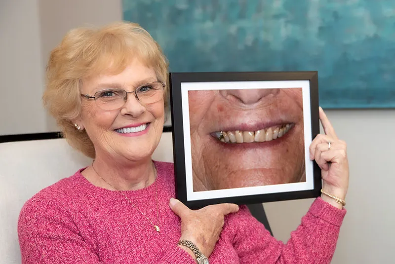 Marilyn, a Smileology&reg; full-arch implant patient, smiling
