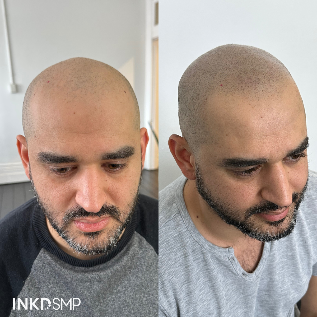 SMP hairline enhancement result