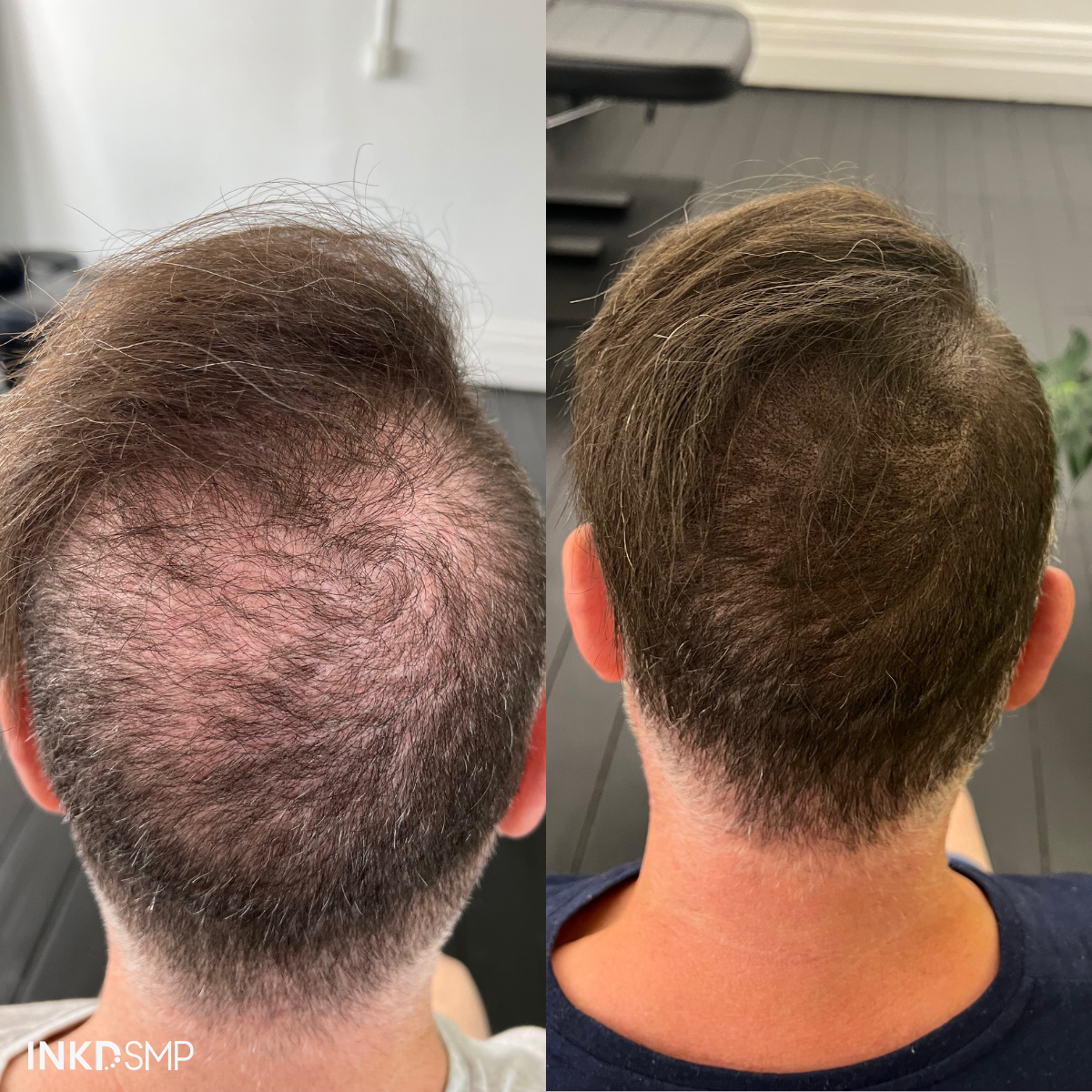 SMP hairline restoration