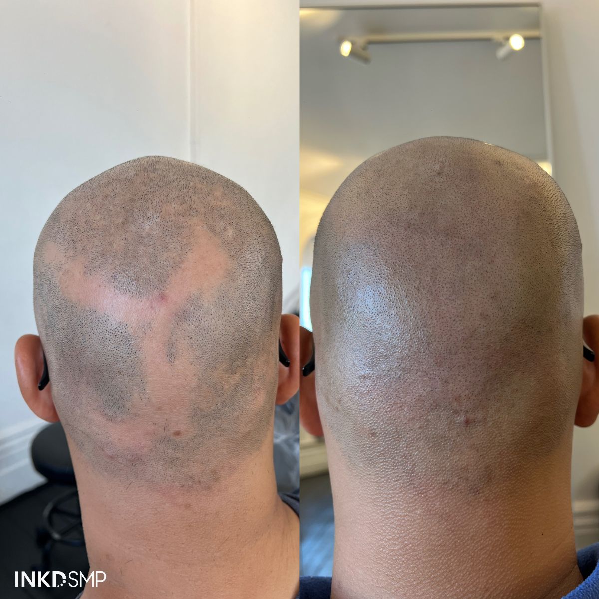 SMP alopecia result