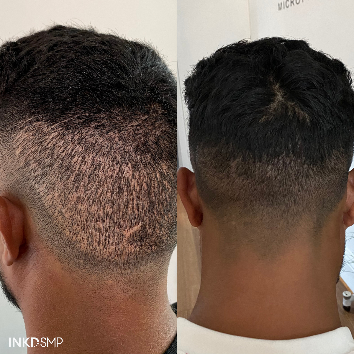 SMP FUE transplant scar result