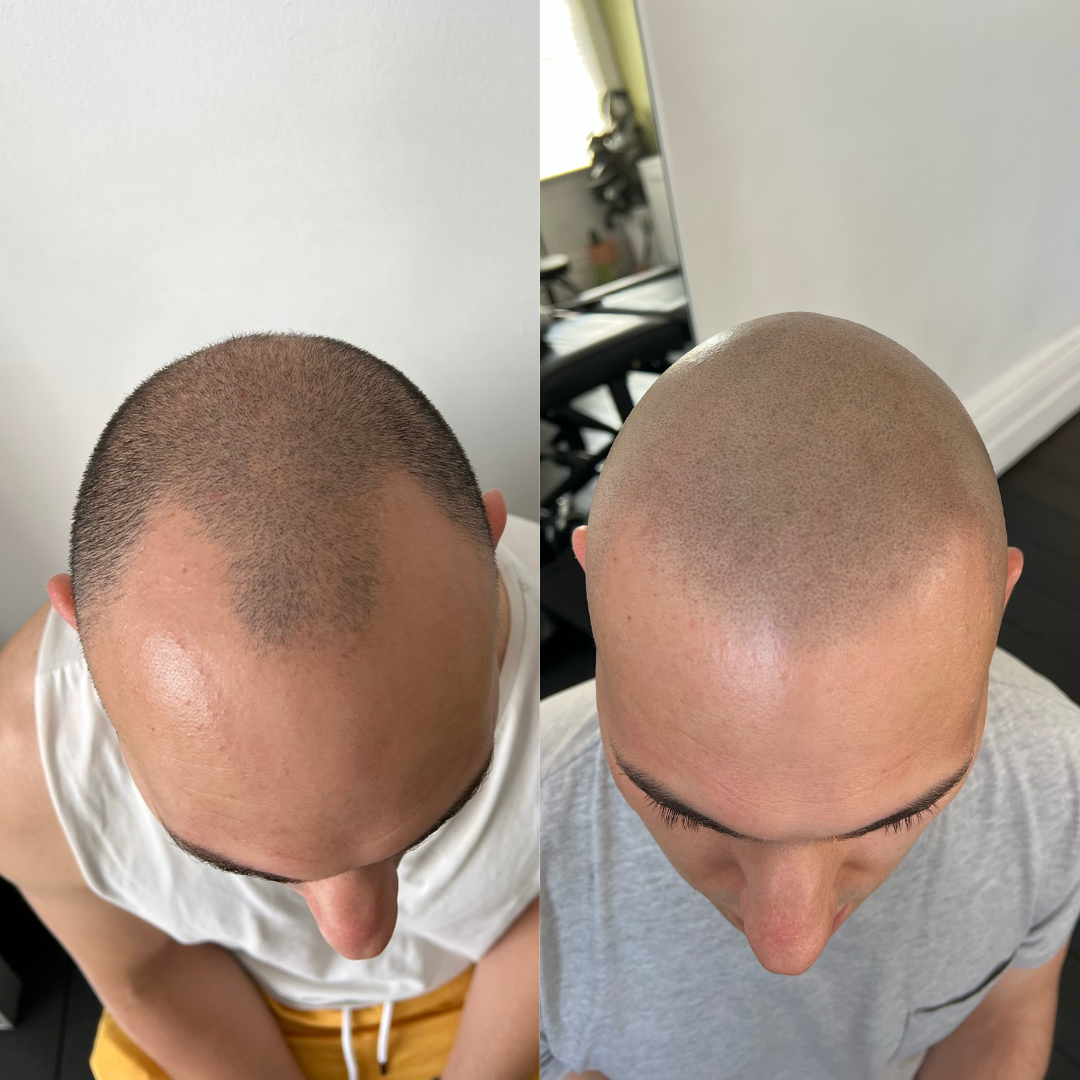 SMP hairline enhancement result