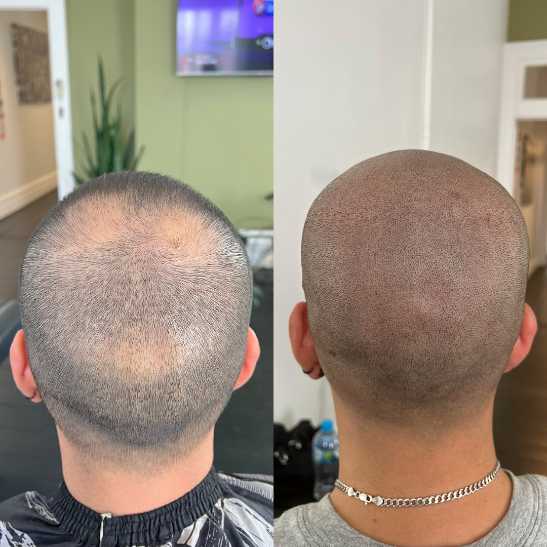 SMP alopecia result