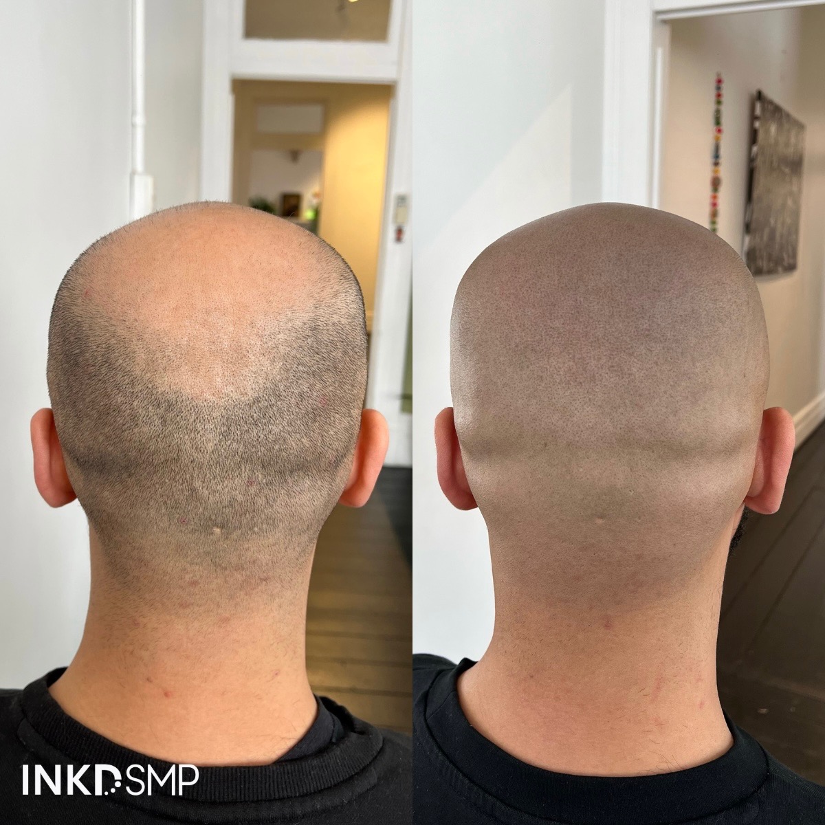 SMP shaved head treatment result