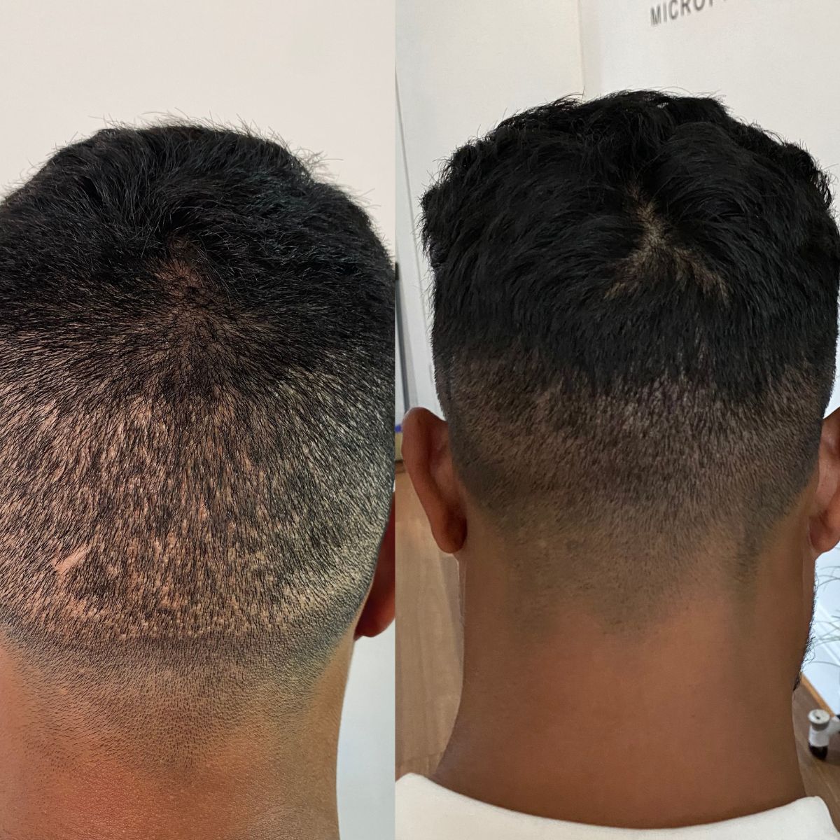 SMP FUE transplant scar result