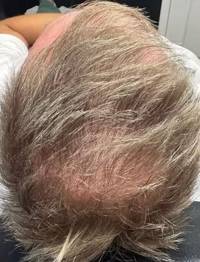 Scalp before MicroDensa treatment