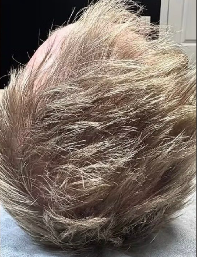 Scalp after MicroDensa treatment
