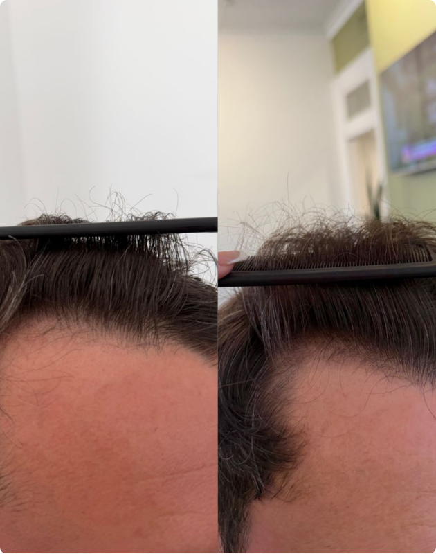 MicroDensa™ + Density SMP · 3 sessions · 14 weeks