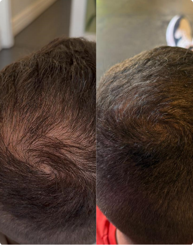 MicroDensa™ · 3 sessions · 12 weeks