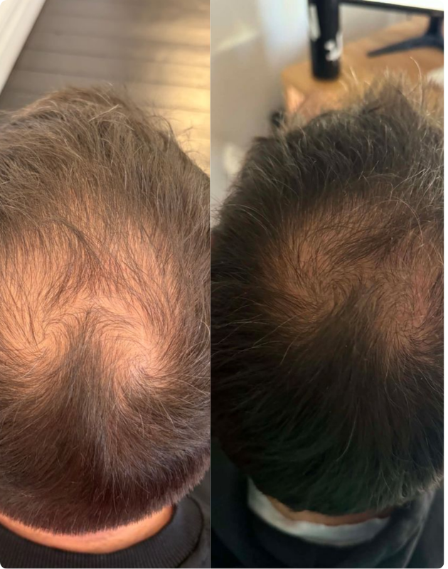 MicroDensa™ · 4 sessions · 12 weeks