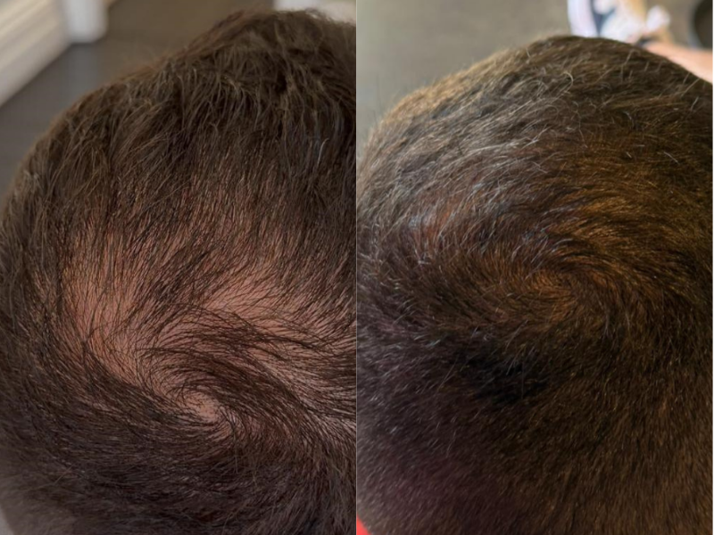 MicroDensa before and after result 1