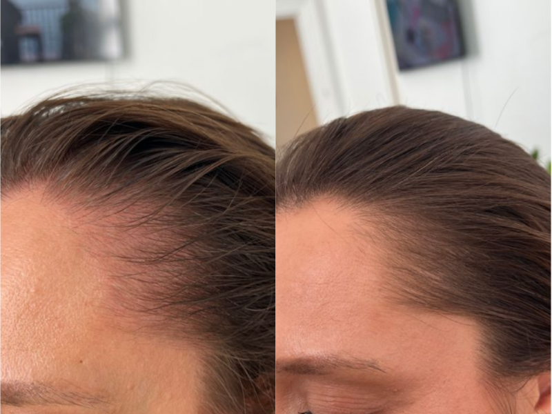 MicroDensa before and after result 4