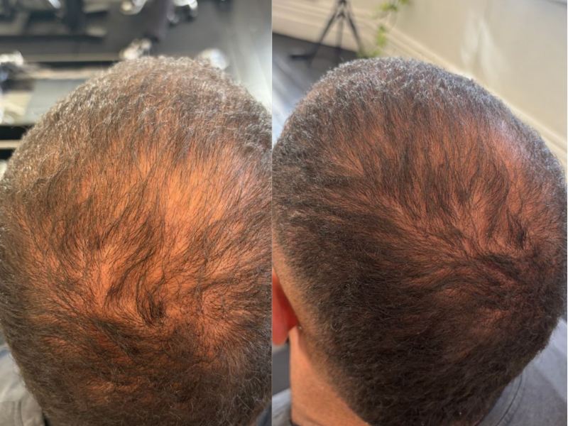 MicroDensa before and after result 2