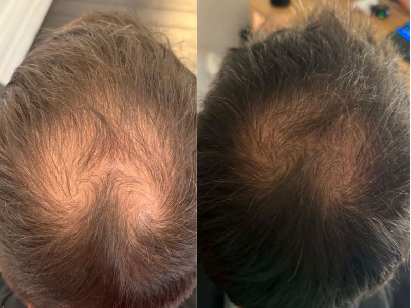 MicroDensa before and after result 5