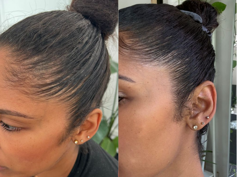 MicroDensa before and after result 3