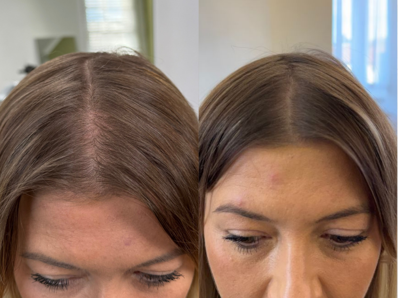 MicroDensa before and after result 6