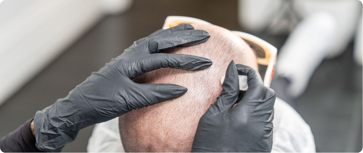 MicroDensa treatment protocol and capture standards