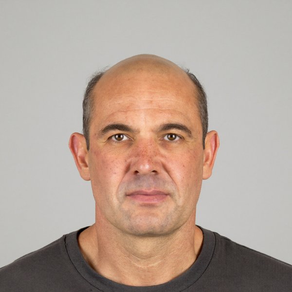 advanced hair loss with a horseshoe pattern