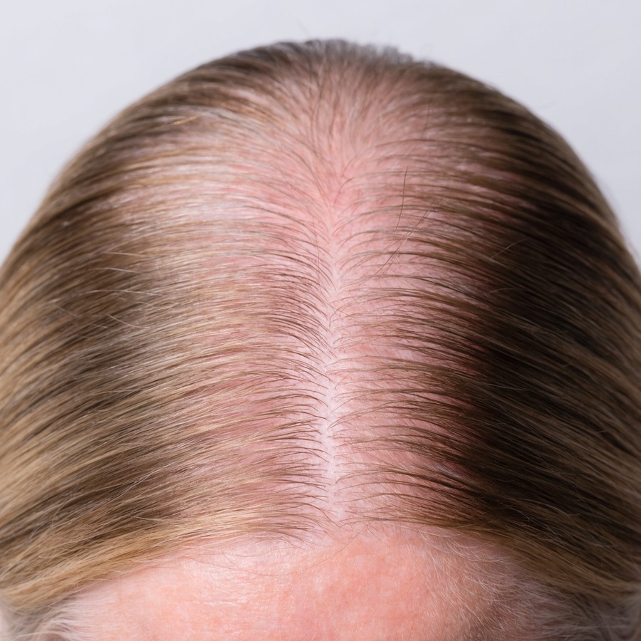 A widened part with the scalp showing through, typical of female pattern thinning