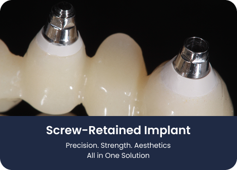 screw retained