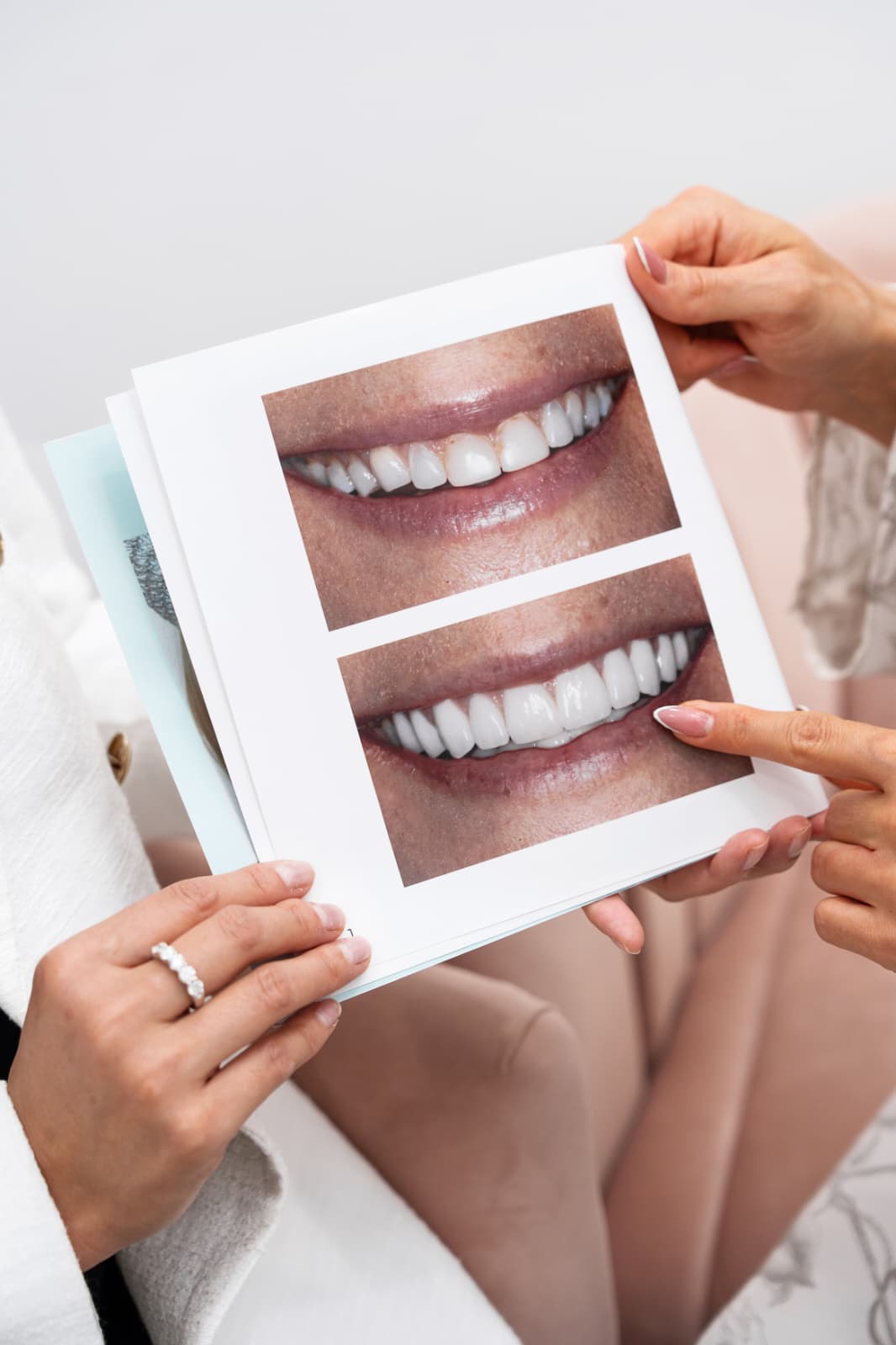 Improving a smile conservatively article