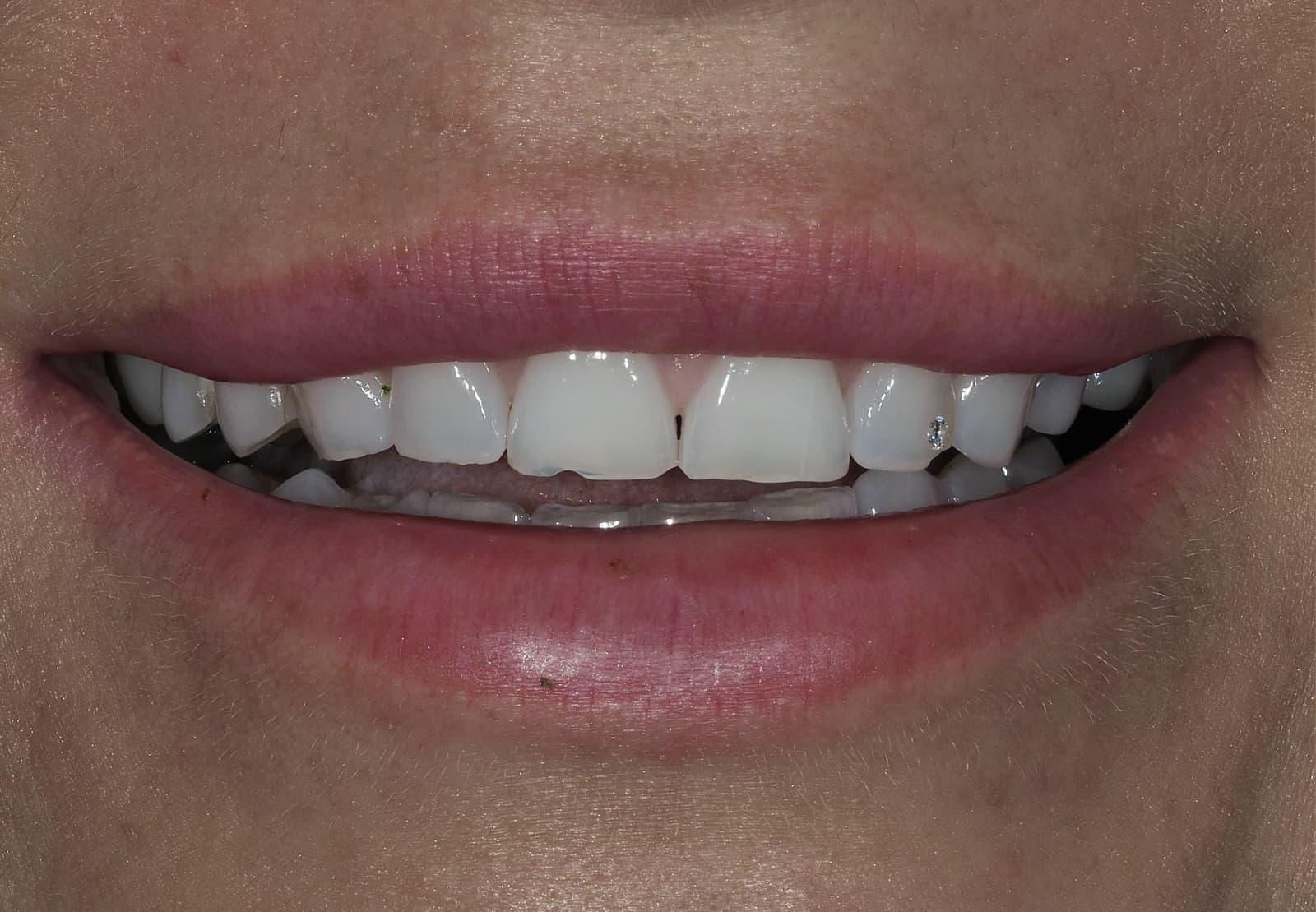 Smile after treatment