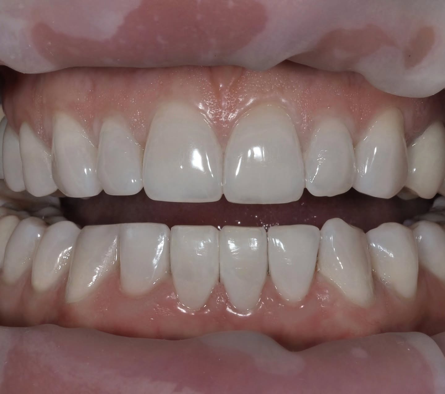 After — spaces closed with artistic composite bonding